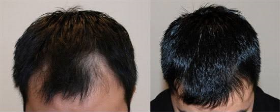 alopecia